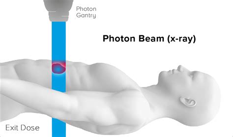 Photon Beam Radiation Therapy All About Radiation