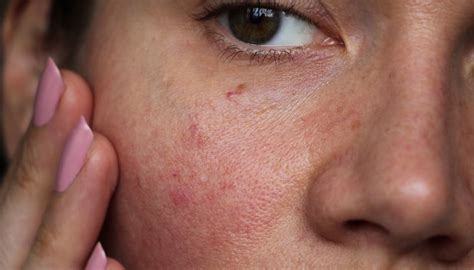 How Do You Treat Sensitive Skin Dermalogica Uk