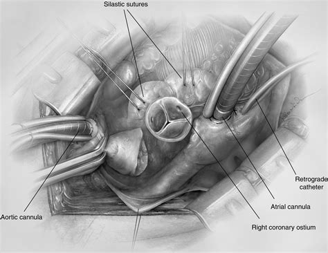 Valve Sparing Aortic Root Replacement—“t David V” Method Operative