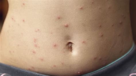 Warning Issued After Five More People Contract Measles In