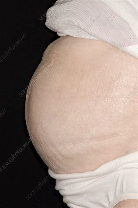 Ascites Distended Abdomen In Cancer Stock Image C008 5715 Science Photo Library