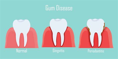 Gum Disease Friendly Smiles Dental
