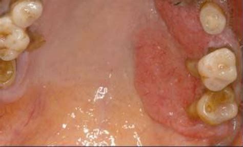 Scielo Brasil A Rare Case Of Giant Verruciform Xanthoma In The
