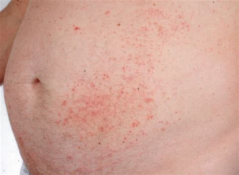 Treating Dermatitis With Clinical Hypnosis