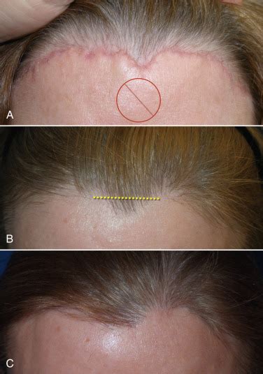 Brow And Forehead Lift Form Function And Evaluation Plastic