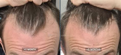 head massage for hair growth types and causes of hair loss