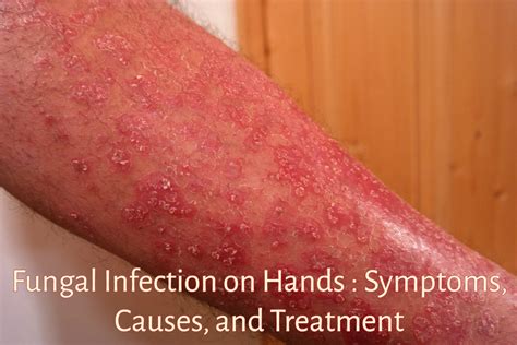 Fungal Skin Rash On Hands Images And Photos Finder