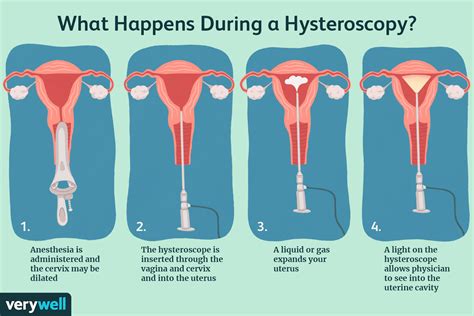 Normal Hysteroscopy