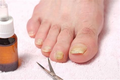 What Kills Nail Fungus Fast Everything You Need To Know About Nail Fungus
