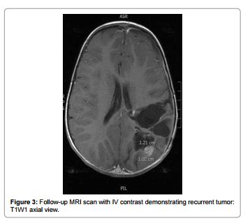 Prolonged Survival For Choroid Plexus Carcinoma With Oncocytic Changes