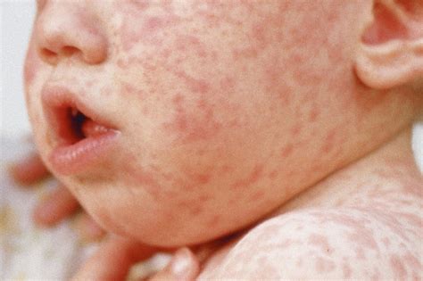 Rashes In Babies And Children Nhs