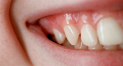 Gum disease is caused by bacteria found in plaque and tartar. How to Maintain Healthy Teeth and Gums - CuencaHighLife