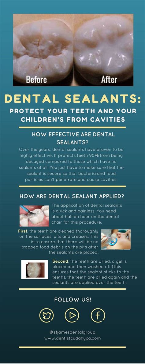 Dental Sealants Are Protective Covering Of The Teeth To Keep It From