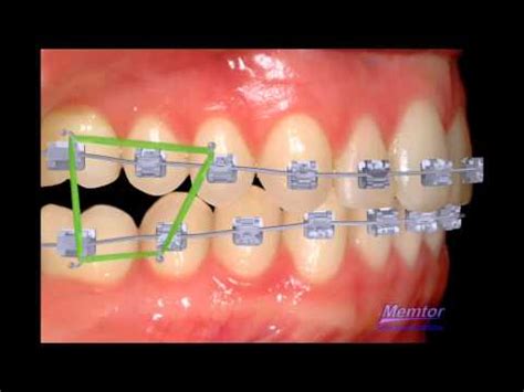 Are you wondering how to fix a crossbite in adults? Rubber band to correct posterio open bite-orthodontist ...