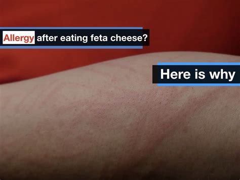 5 Reasons Allergic To Feta Cheese