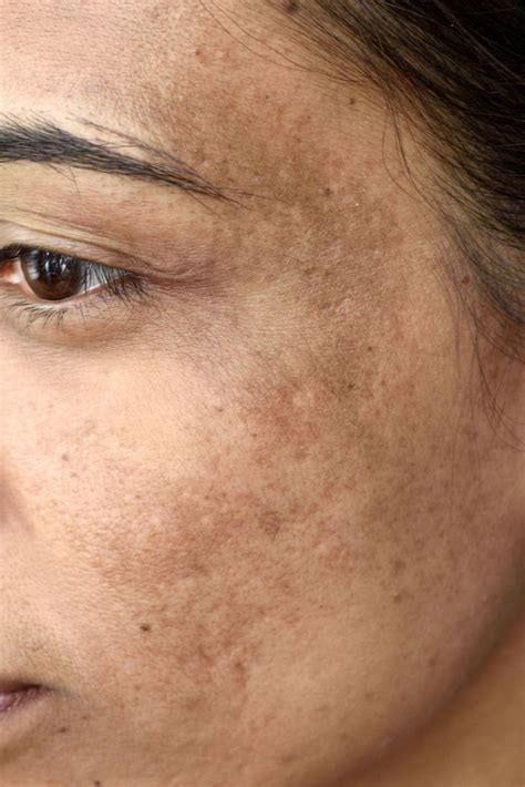 8 Common Skin Problems And How To Fix Them Dark Patches On Skin