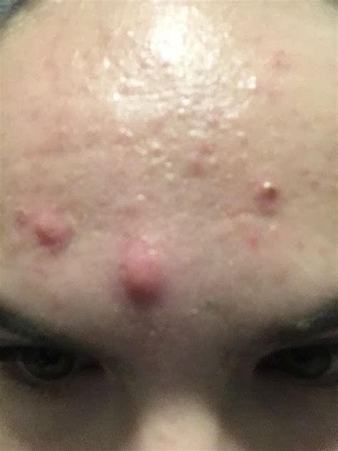 Red Bumps On Forhead Renew Physical Therapy