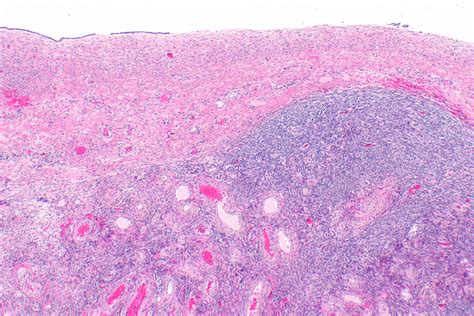 We did not find results for: Can Serous Cystadenoma Turn Into Cancer - CancerWalls