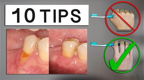 How To Reverse Periodontal Disease Naturally