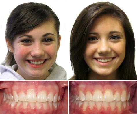 Voss dental in houston texas can fix overbite using invisalign. Braces Before and After | Children & Family Dentistry & Braces