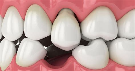 Loose Teeth And Gum Disease Monroe Ct Dr Richard Amato