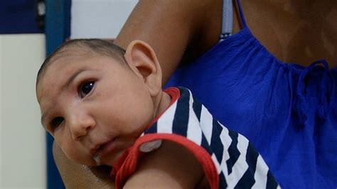 Zika Virus Caused Birth Defects In 5 Of Infected Women Us