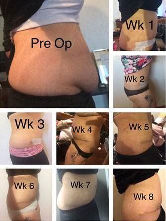 Tummy Tuck Before And After Pics And Image Tummy Tuck Prices Photos