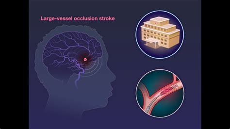 Endovascular Therapy For Large Cerebral Infarction Nejm Youtube