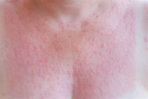 Sun Rash What To Know About Photosensitivity Waters Edge Dermatology