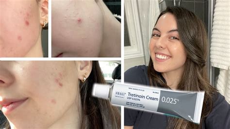 How I Cleared My Skin In 1 Month Tretinoin Cream 0025 Before And