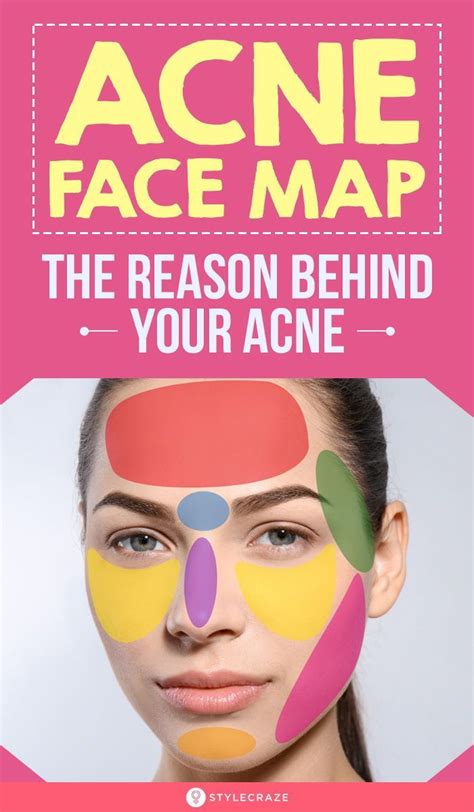 Acne Face Map The Reason Behind Your Acne Acne On Your Face Is More