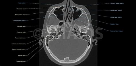 The ct test is usually made to evaluate the anatomy of the paranasal sinuses. Pin on Anatomia