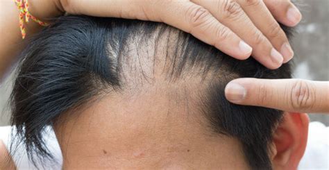 I Have An Itchy Scalp Do I Have Scalp Psoriasis Orlando Fl Dr