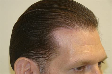Hair Transplant Hairline The Best In Field Results Dr Brett Bolton