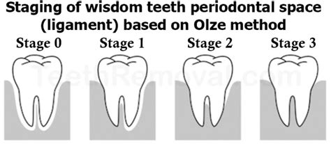 Using Panoramic X Rays Of Lower Wisdom Teeth To Legally Prove If