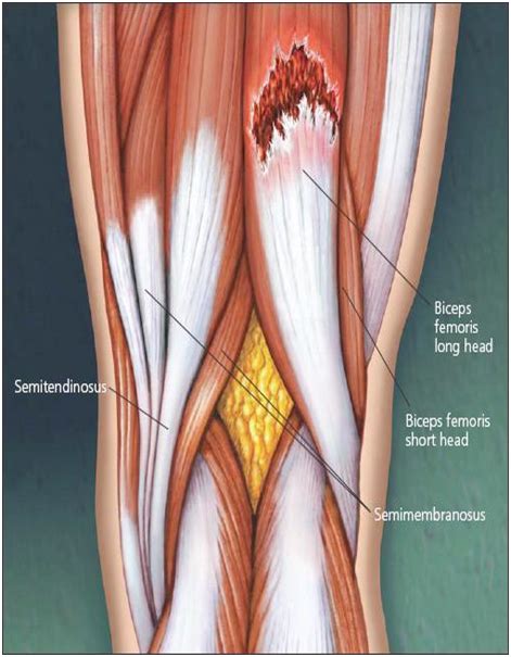 Hamstring Strain A Strain Is The Tearing Of A Tendon Or