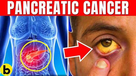 Early Warning Signs Of Pancreatic Cancer You Should Never Ignore
