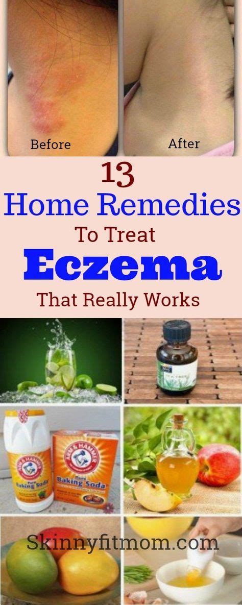 Best Way To Treat Eczema