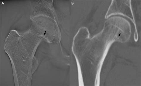 Occult Fracture Of The Femoral Neck Associated With Extensive
