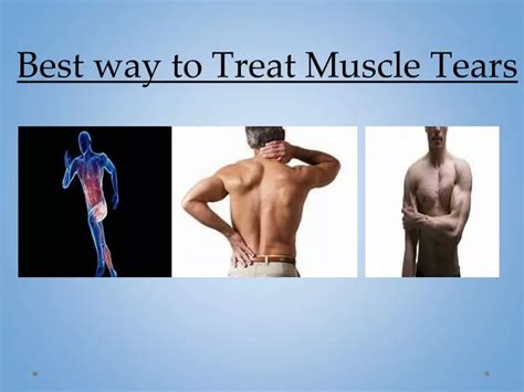 Ppt Best Way To Treat Muscle Tears Powerpoint Presentation Free