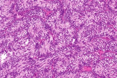 Photomicrograph Of Adult Granulosa Cell Tumor Histopathology Tumor Download Scientific Diagram