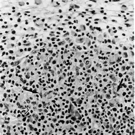 Histiocyte Like Cells With Dense Lamellar Inclusions In Mitochondria