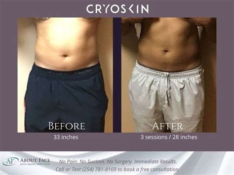Cryoskin Slimming Treatment Before And After About Face