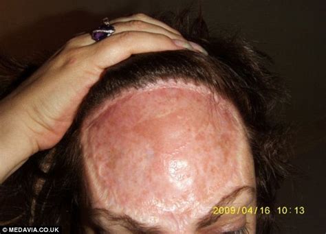 Woman With Rare Cancer Has 85 Of Her Forehead Removed Daily Mail Online