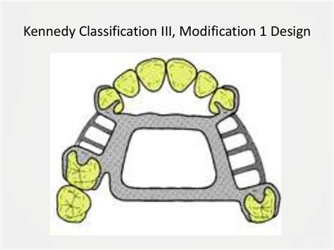 Designing A Removable Partial Denture Kennedys Classification