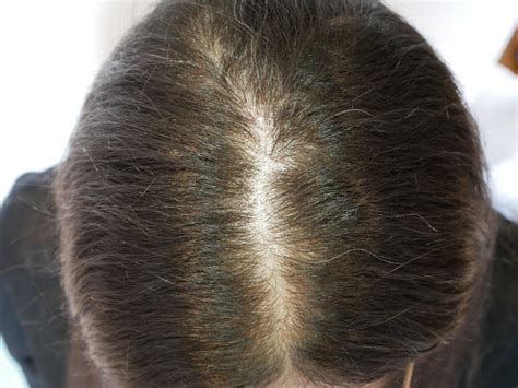 Female Pattern Hair Loss During The Pandemic The Hairdresser Asked If