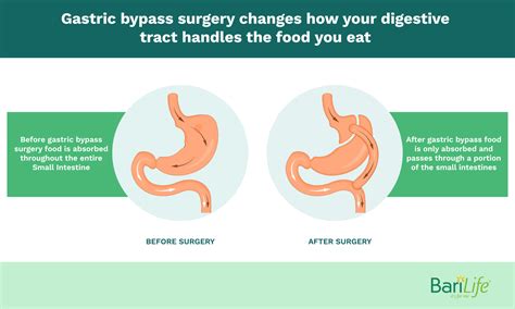Gastric Bypass Reversal What Happens After Its Reversed