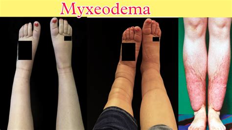 Myxedema What Is Myxeodema Sign And Symptoms Diagnosis — Gs India