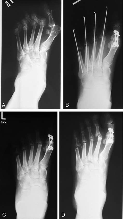 Sustainability Of Forefoot Reconstruction For The Rheumatoid Foot The
