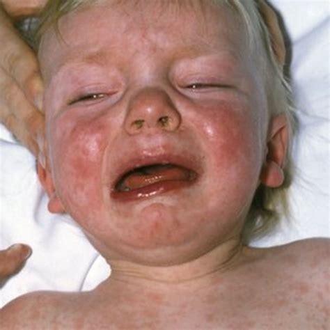 Threat To Measles Elimination Plans Bbc News